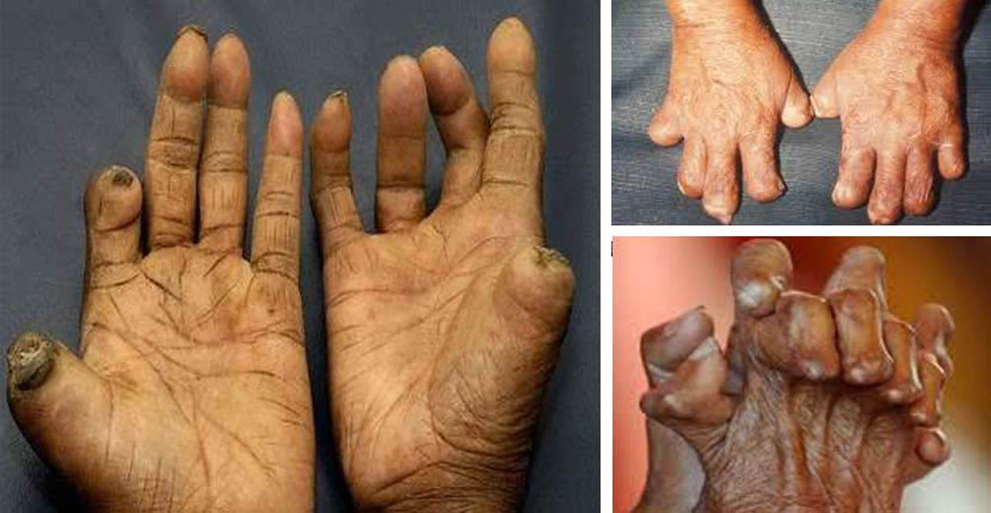 पाल्पामा १७ जना कुष्ठरोगी